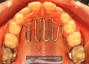 Anti-habit Appliance Anti-habit Appliance