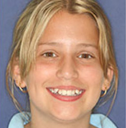 Orthodontic treatment before