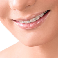 Clear braces Clear braces