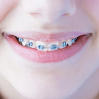 Metal braces Metal braces